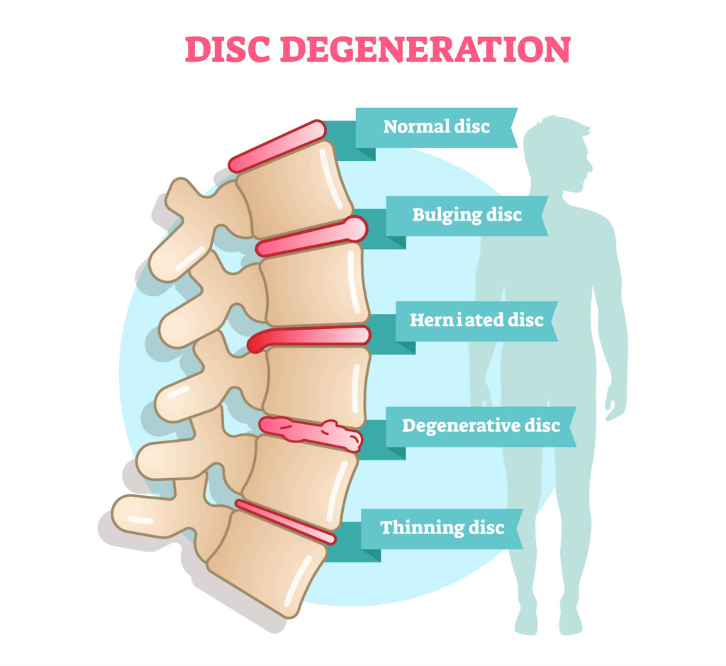 disc degeneration illustration