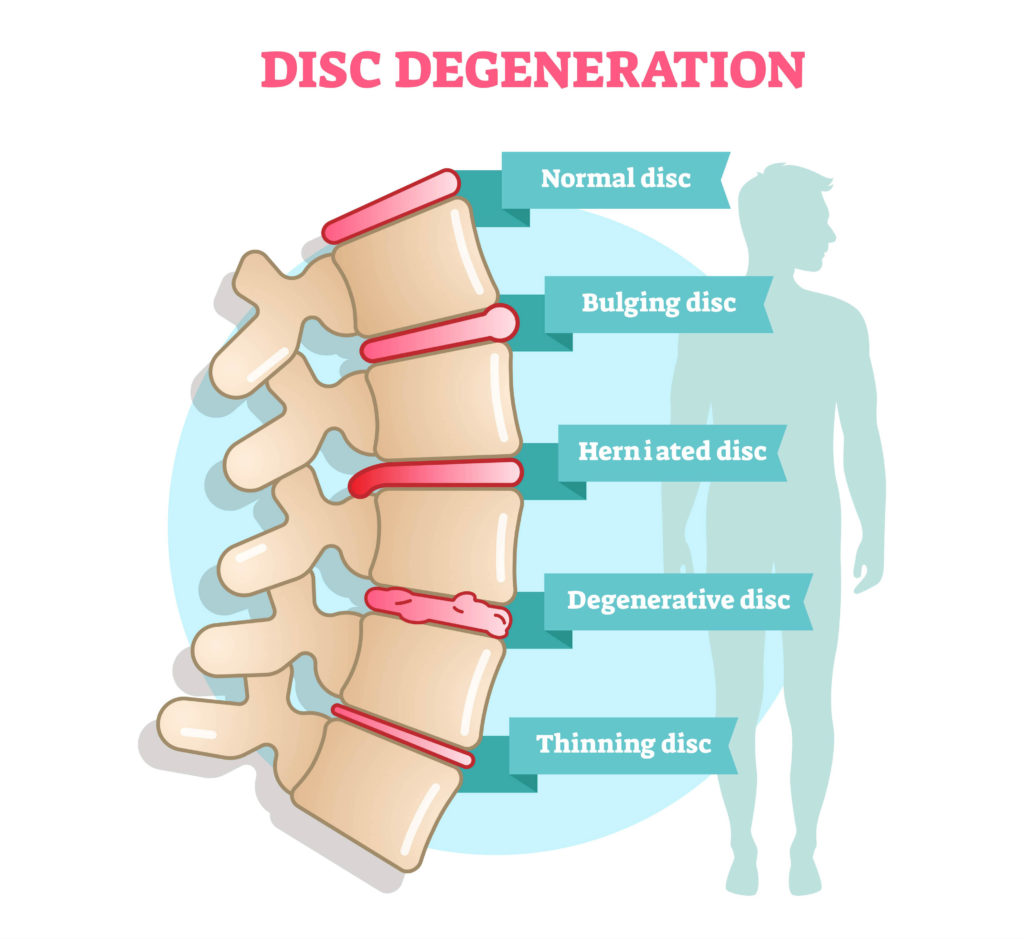 Herniated Disc - Apollo Physical Therapy Centres