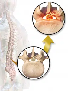 Illustration of Spinal Stenosis 
