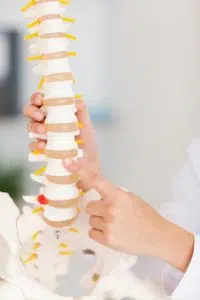 Chiropractor holding a model of a the human spine with a herniated disk 