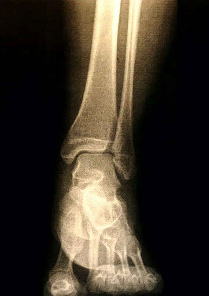 x-ray image of a patients foot