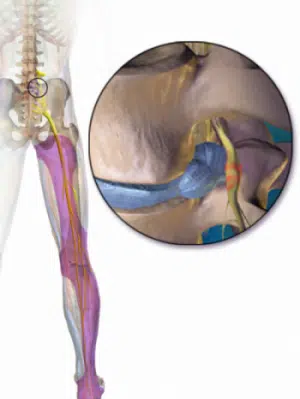 illustration of a pinched nerve in the hip