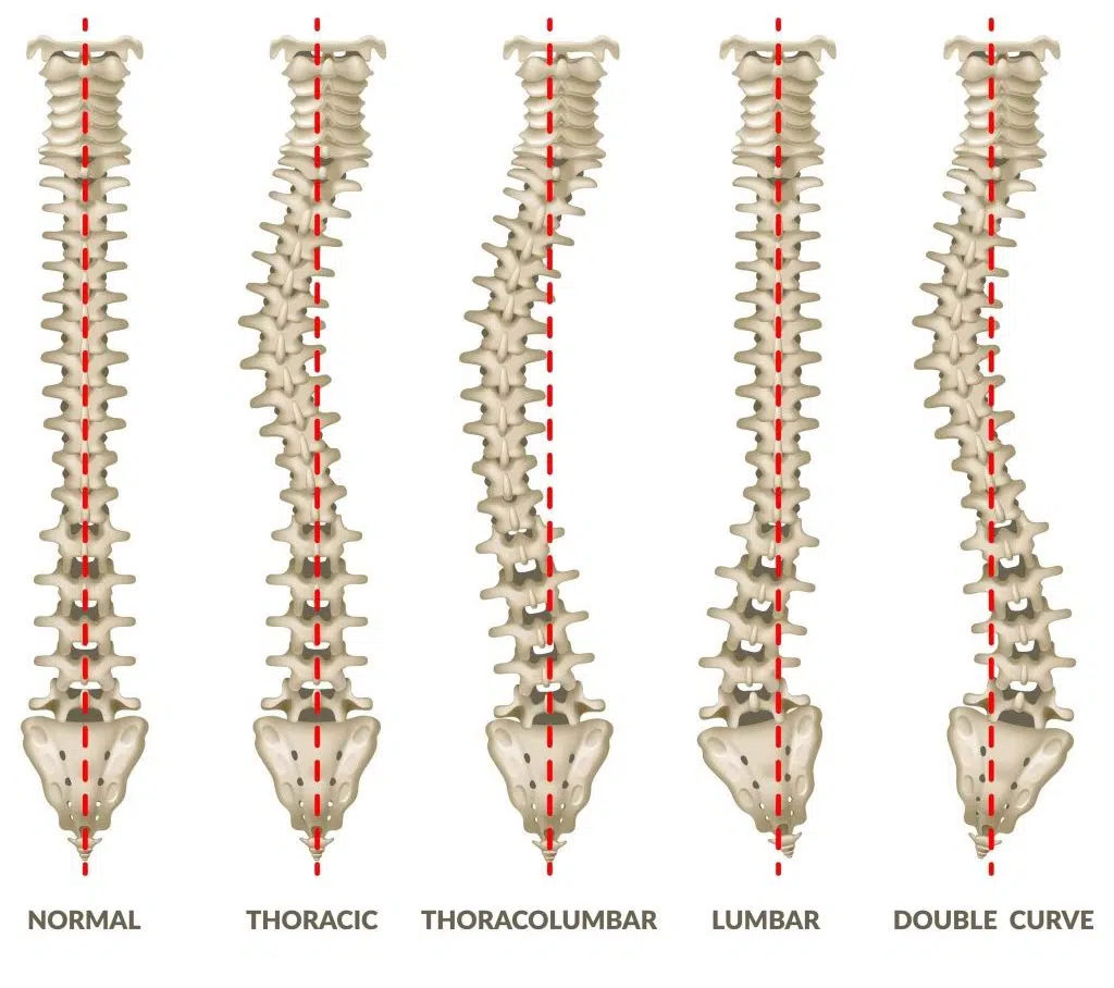 Illustration of Scoliosis-Types